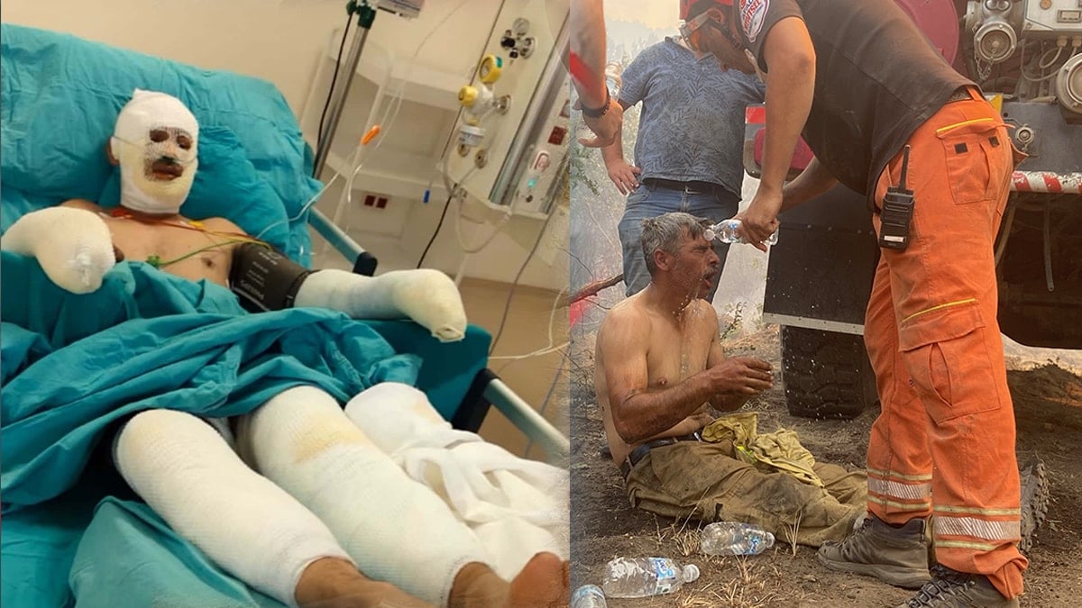 Orman yangınında yaralanan orman işçisinin son hali ortaya çıktı Orman yangınında yaralanan orman işçisinin son hali ortaya çıktı