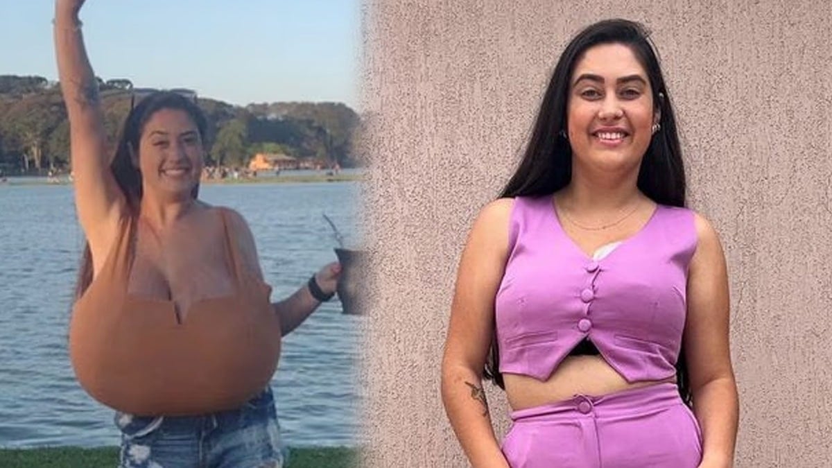 Sadece 300 kişide görülen hastalık: Göğüsleri aylar içinde 12 kiloya ulaştı Sadece 300 kişide görülen hastalık: Göğüsleri aylar içinde 12 kiloya ulaştı